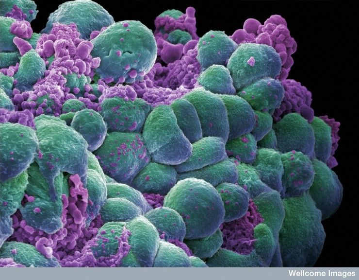 Cancer les cellules tumorales ne supportent pas la pression